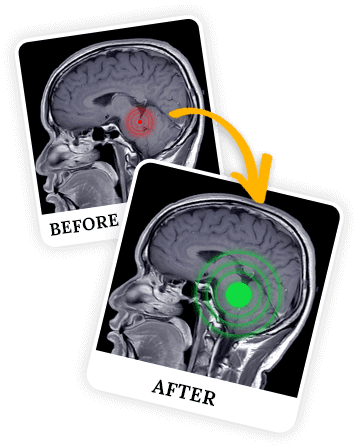 The Genius Wave Before & after results